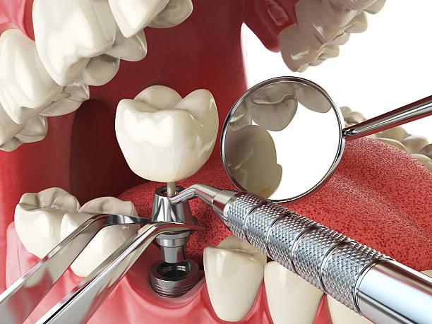 Best Emergency Dental Care for Broken or Chipped Teeth in Spearman, TX